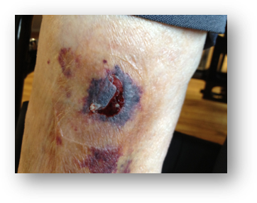 Lower Limb skin tear Lower Limb skin tear